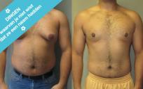 Gynecomastie